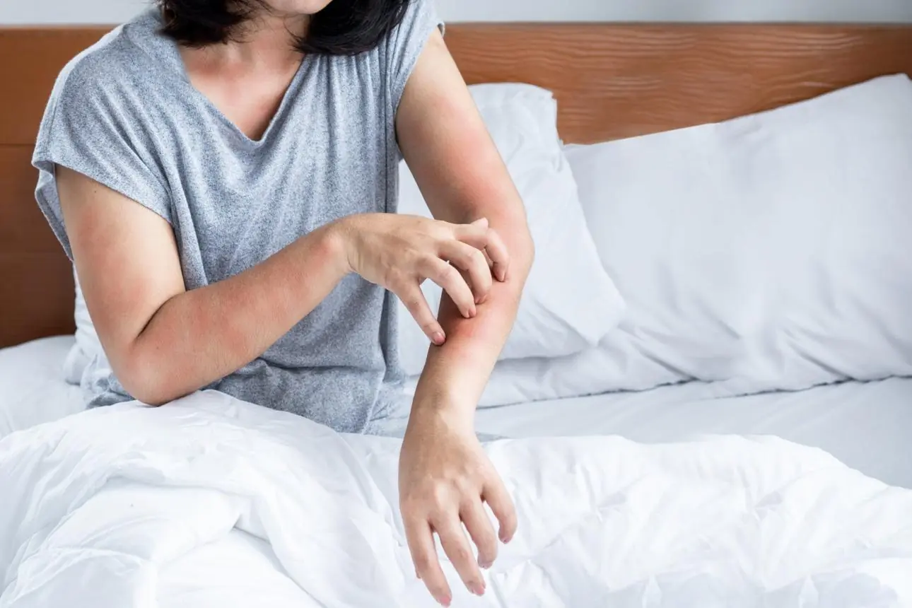What Really Happens After Bed Bug Bites? Symptoms, Treatment, and Prevention