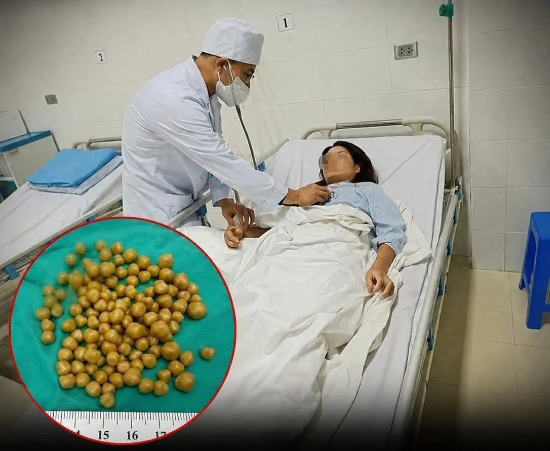 Months of Bloating, Then a Shocking Discovery. 130 Mystery "Seeds" Found Inside During Surgery