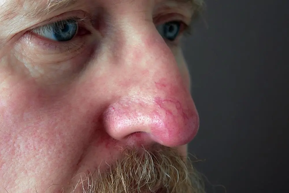 5 Warning Signs on Your Nose That Could Point to Serious Health Problems