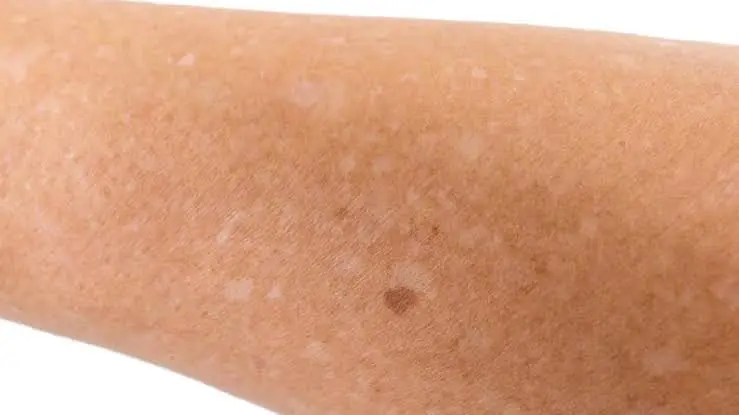 These Tiny White Spots on Your Arms or Legs Might Reveal More Than You Think