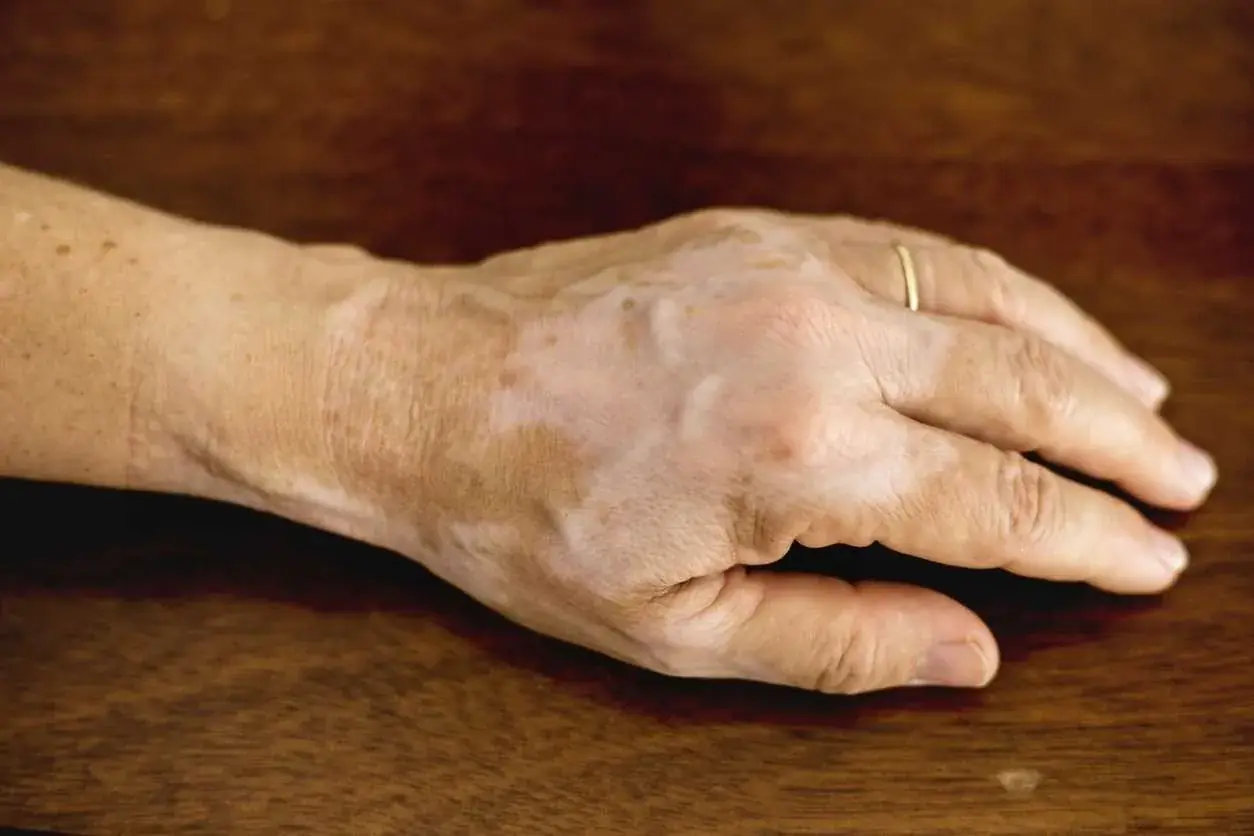 If Your Hand Veins Seem More Noticeable, Don't Panic—Here's What to Know