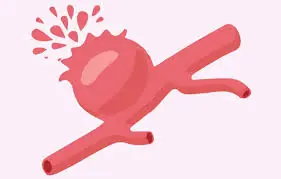 Think You Know the Symptoms of an Aneurysm? Here Are the Most Important Ones