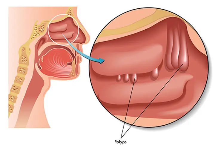 These 5 Nose Symptoms Could Be Signs of an Underlying Health Issue