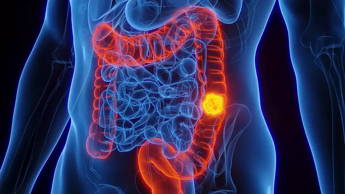 A 56-Year-Old Man Was Diagnosed With Colorectal Can.cer After Having a Bowel Movement Only Once a Day