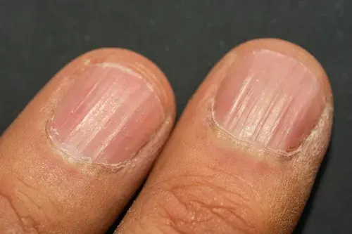 Over 40? These Common Nail Changes May Offer Clues About Your Health