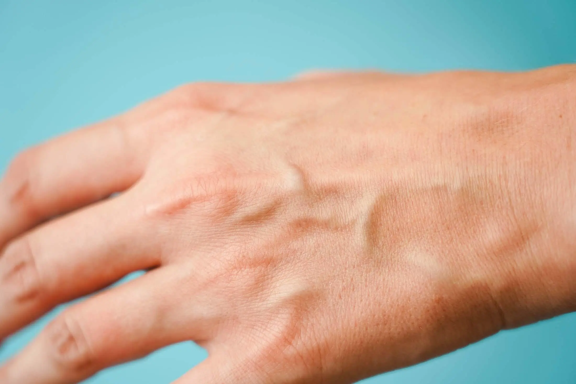 Why Are Your Veins Suddenly Bulging? Experts Reveal What Visible Veins Could Mean
