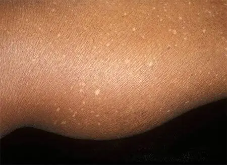 Small White Spots on Your Arms or Legs Are More Common Than You Think—Here's What They May Mean