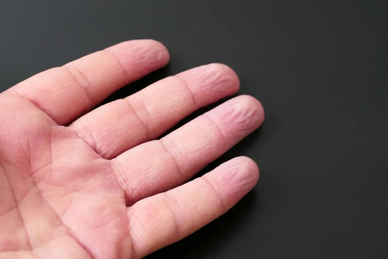 Wrinkled Fingers All the Time? Here Are the Possible Health Conditions Behind It