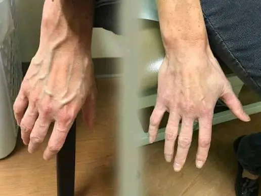 Take a Close Look at Your Veins — They May Reveal More Than You Realize
