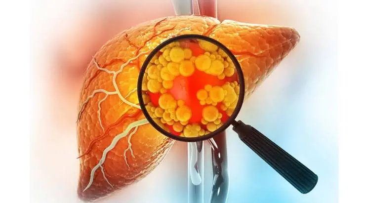 Fatty Liver Disease Can Be Silent at First — Know the Signs Before They Progress