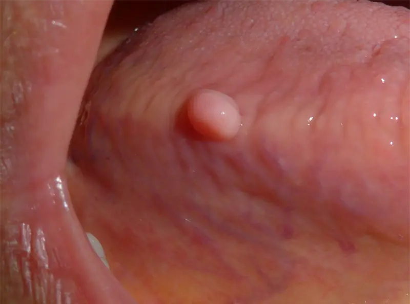These Mouth Changes Could Be Clues to an Underlying Health Condition