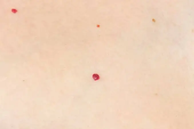 Your Skin May Be Sending Important Clues Through These Tiny Red Dots
