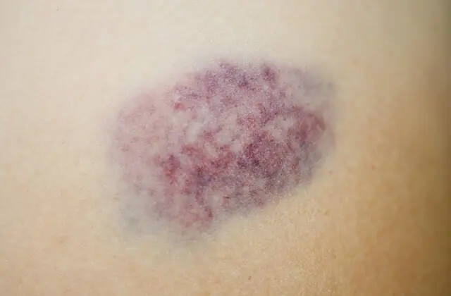 Don't Ignore Frequent or Unexplained Bruises — Learn What They May Indicate