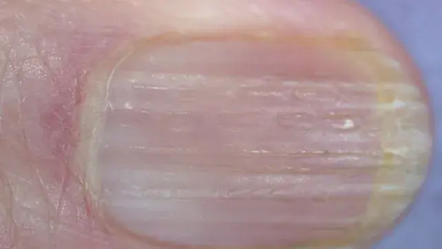 Over 40 and Seeing Lines on Your Nails? Your Body May Be Giving You a Clue