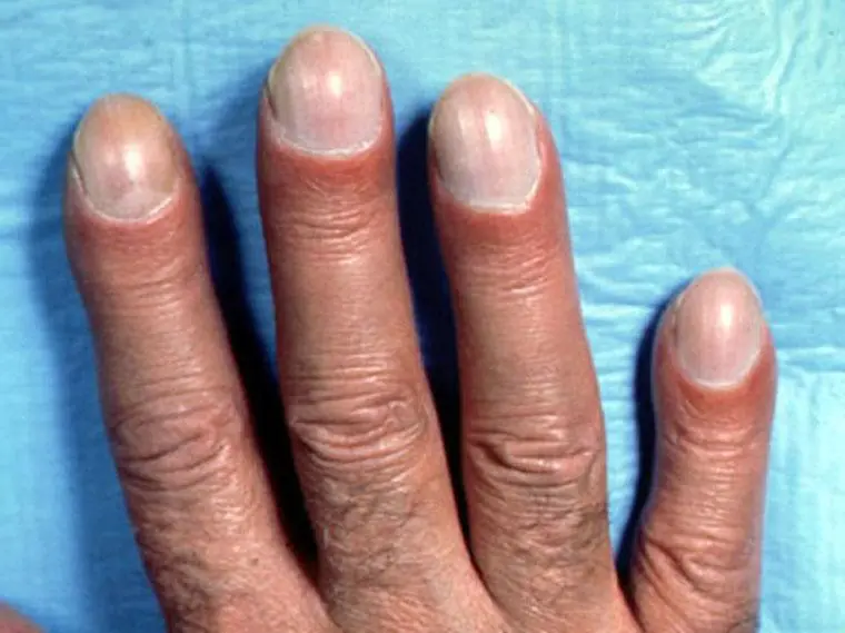 These 4 Nail Changes Could Be Early Warning Signs of Can.cer, According to Oncologists