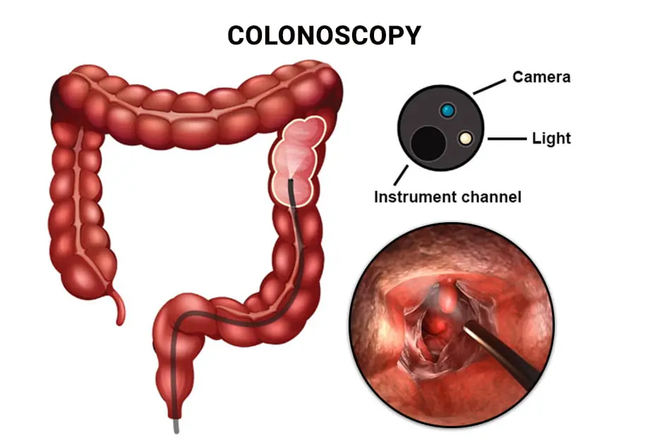 If You're Scheduled for a Colonoscopy, Don't Miss This Important Information