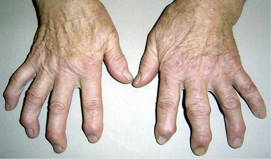My Grandma Has These Hard Bumps Forming on Her Finger Joints Near the Nails. Why Is This Spreading?