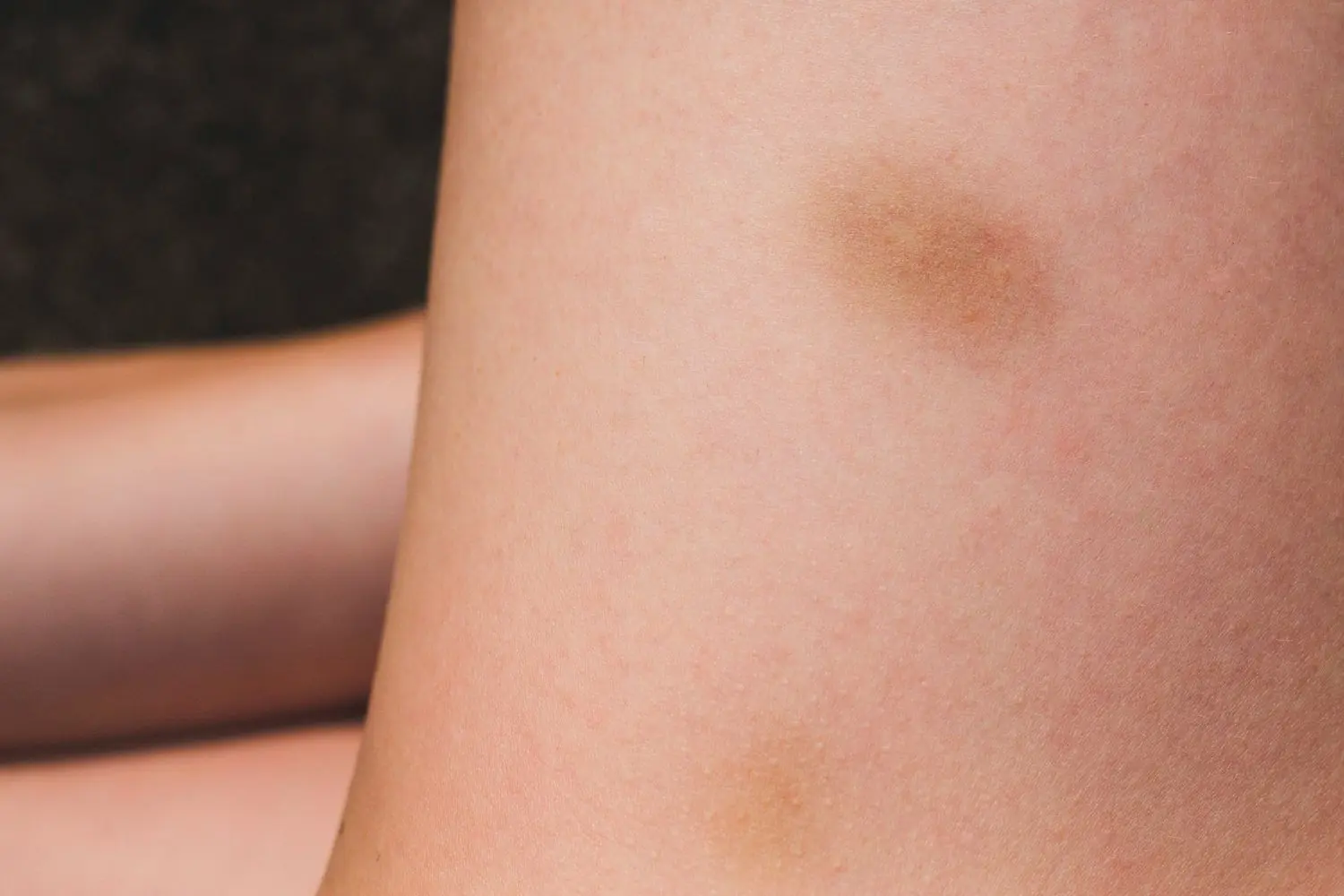 Unexplained Bruises? Here's What They Could Be Telling You About Your Health.