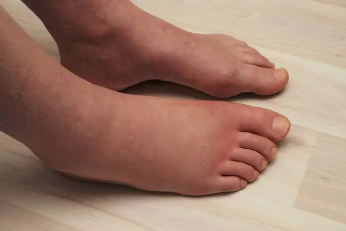 Swollen Feet and Ankles: Common Causes and When to Seek Medical Advice.
