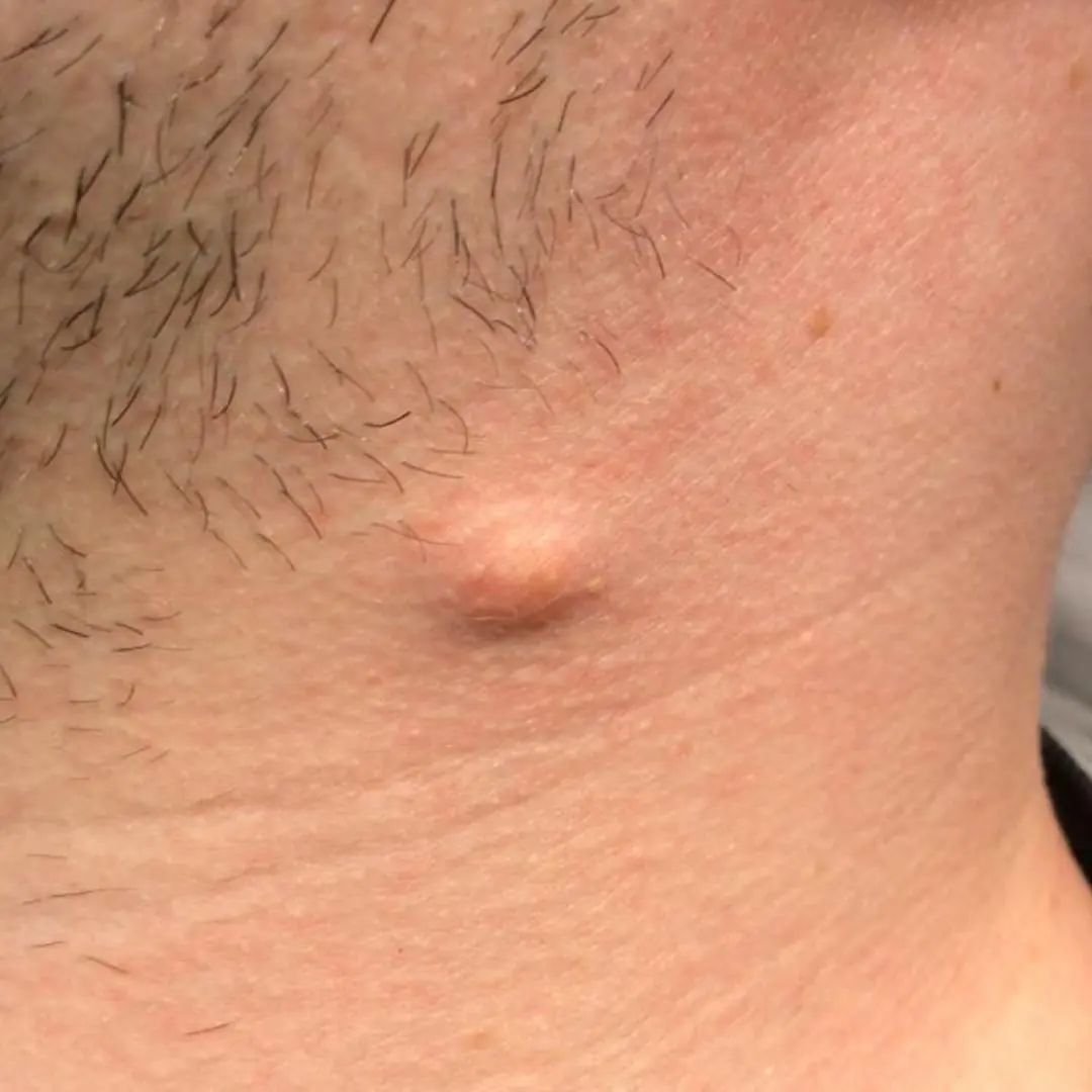 Got a Lump on Your Neck, Back or Behind Your Ear? This Is What You Need to Know