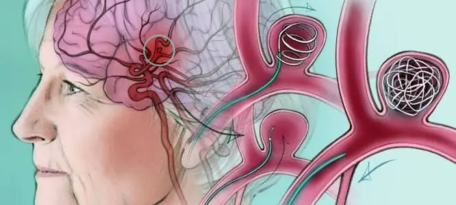 These Symptoms Could Be Linked to an Aneurysm. Here's What Experts Say