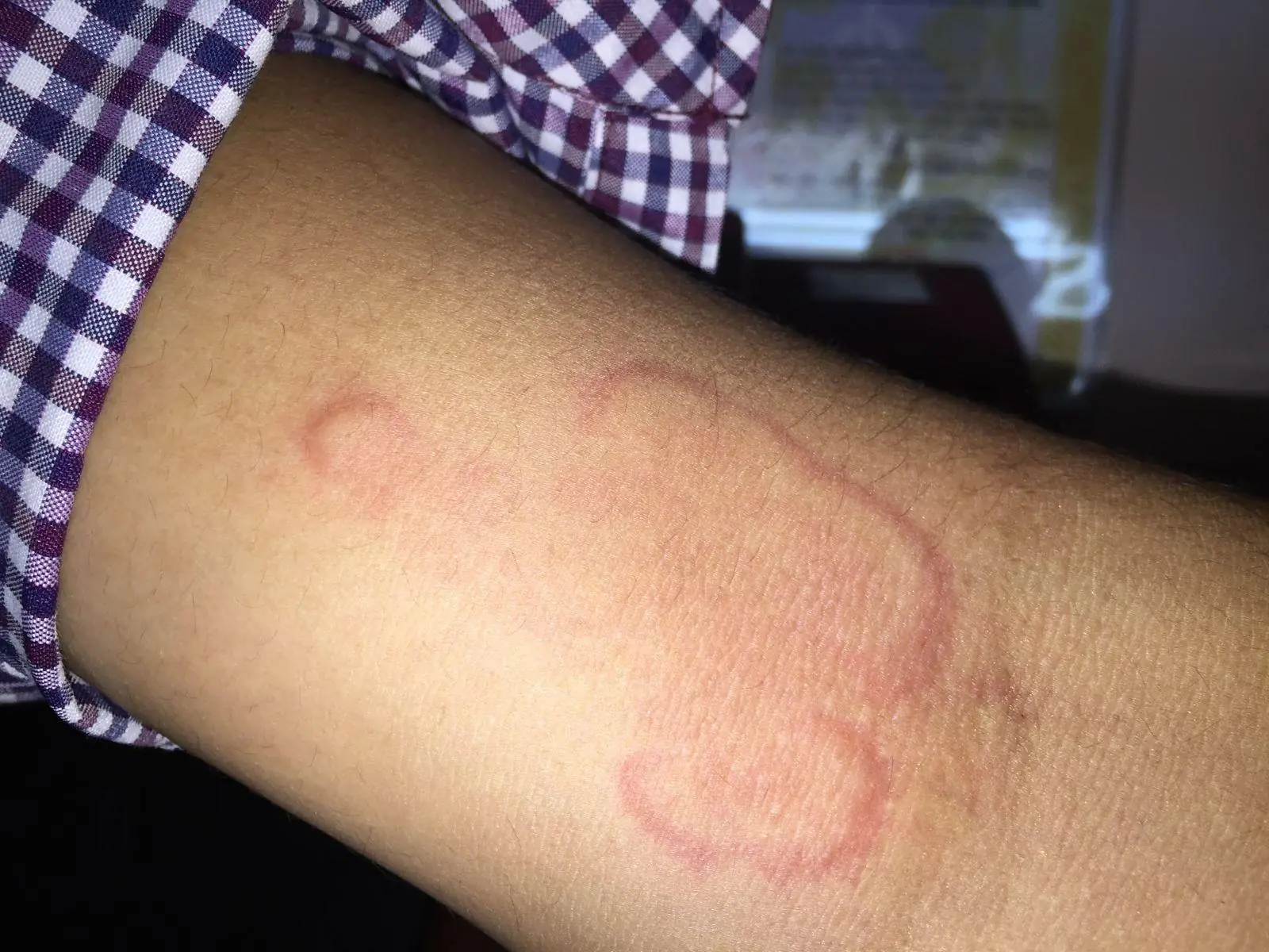 My Daughter Woke Up With a Strange Red Ring on Her Arm: A Parent's Guide to Ring-Shaped Rashes