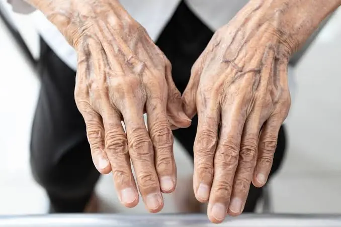 Noticeable Veins on Your Hands or Arms? Here's What They May Mean