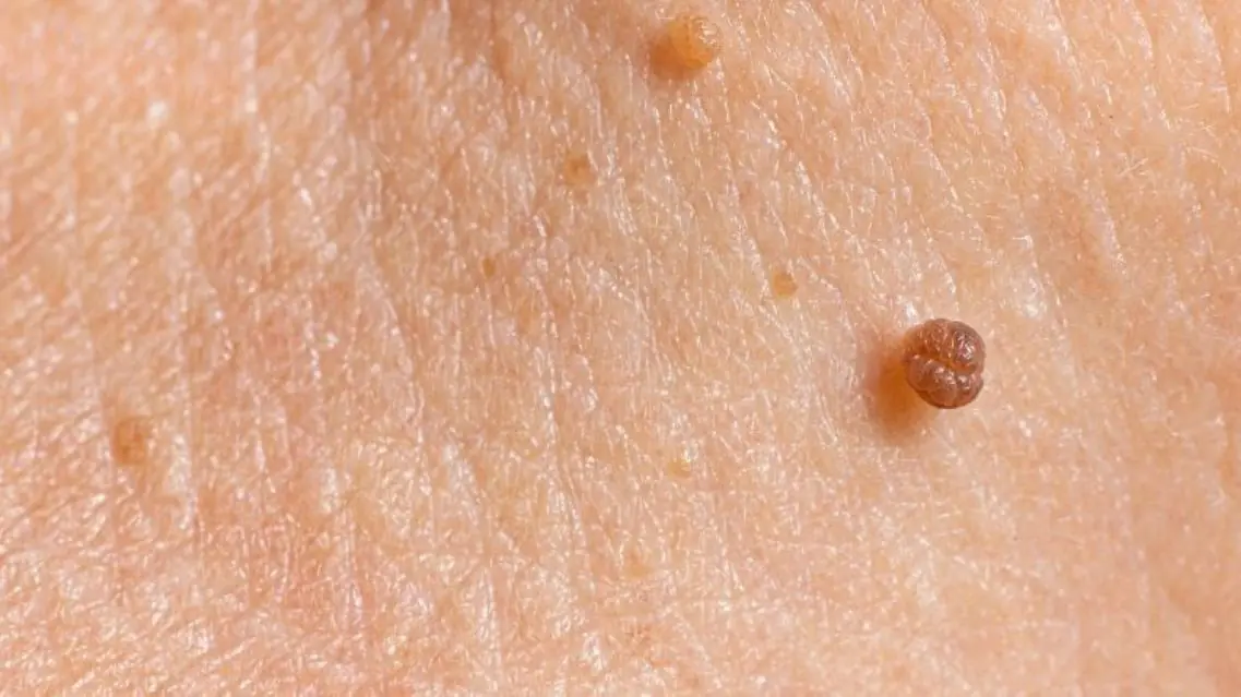 Noticed Bumps on Your Neck? Common Causes and When to Get Them Checked