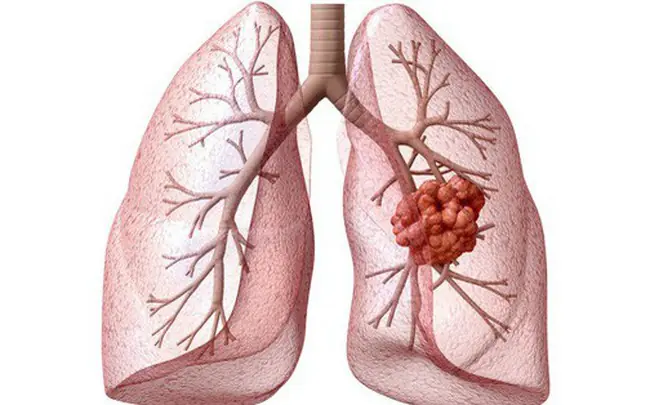 Don’t Overlook These 10 Possible Signs of Lung Can.cer