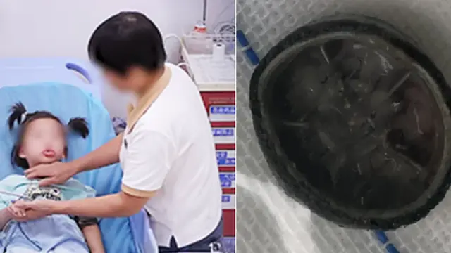 6-Year-Old Girl Coughed for Months—Doctors Removed More Than 3 Liters of Milky Fluid From Her Lungs After Diagnosing a Rare Disease