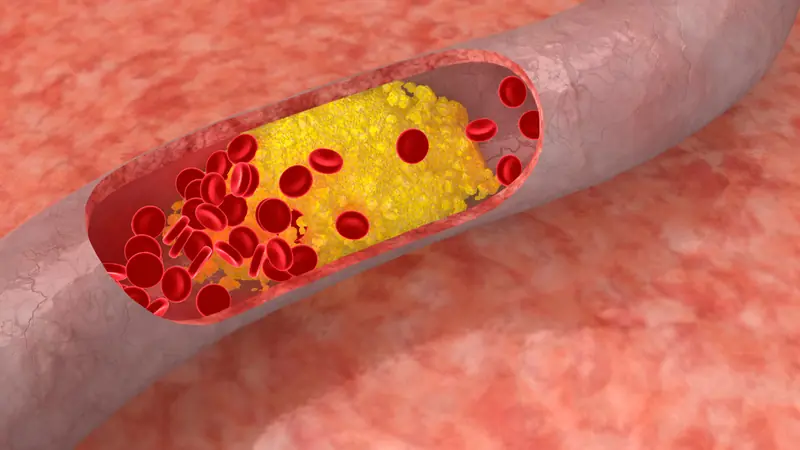 High Cholesterol Often Has No Symptoms - Here's What You Need to Know