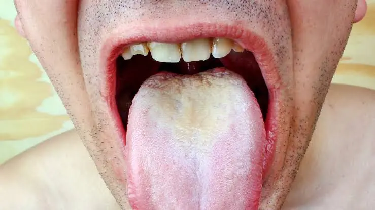 Why Is Your Tongue White? Possible Causes You Should Know About