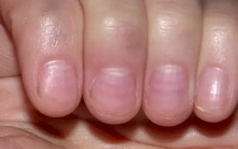 Notice Changes in Your Nails After 40? Here’s What They Could Mean