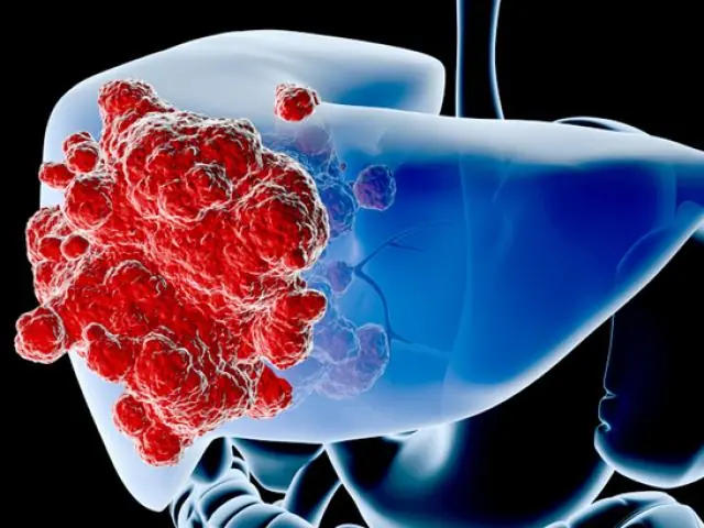 4 Common Conditions That May Be Linked to a Higher Can.cer Risk