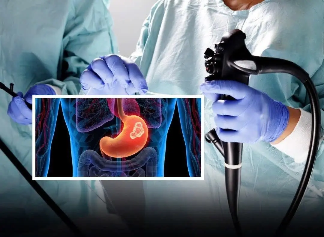 Most cases of stomach can:cer are detected too late. Watch for these 5 after-meal warning signs — and get an early endoscopy before it’s too late
