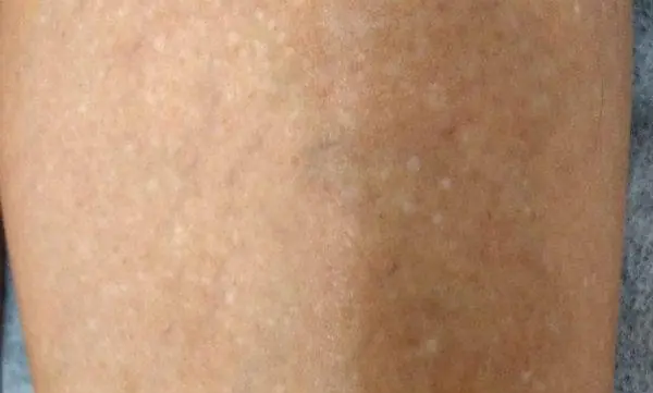 Tiny White Spots on Your Arms or Legs? They Could Be Trying to Tell You Something