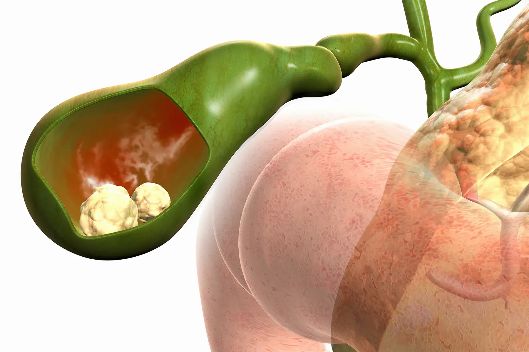 Gallbladder Removed? Here’s What May Happen to Your Digestion and Overall Health