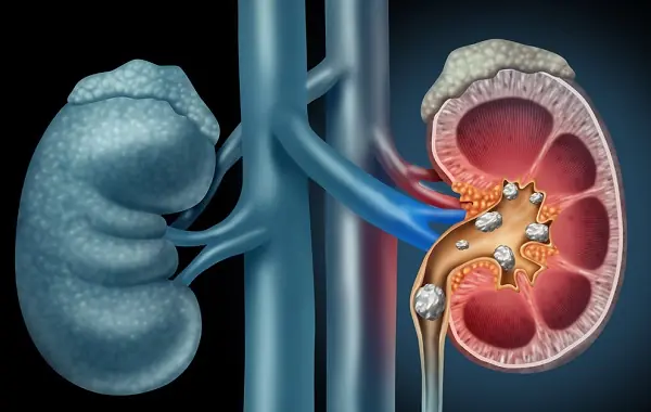 Protecting Your Kidneys: Early Warning Signs and Healthy Habits That Matter