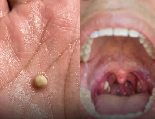 Suddenly Felt Like Something Was Stuck in My Throat… Swallowing Didn’t Help. Then a Strange Lump Came Out. What Was It