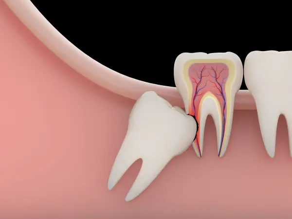 Could You Have an Impacted Wisdom Tooth? 6 Symptoms You Shouldn't Ignore