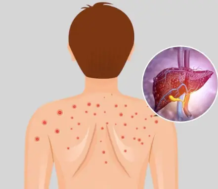 Fatty Liver Explained: Common Causes, Early Signs, Treatment Options, and Lifestyle Changes That Can Help