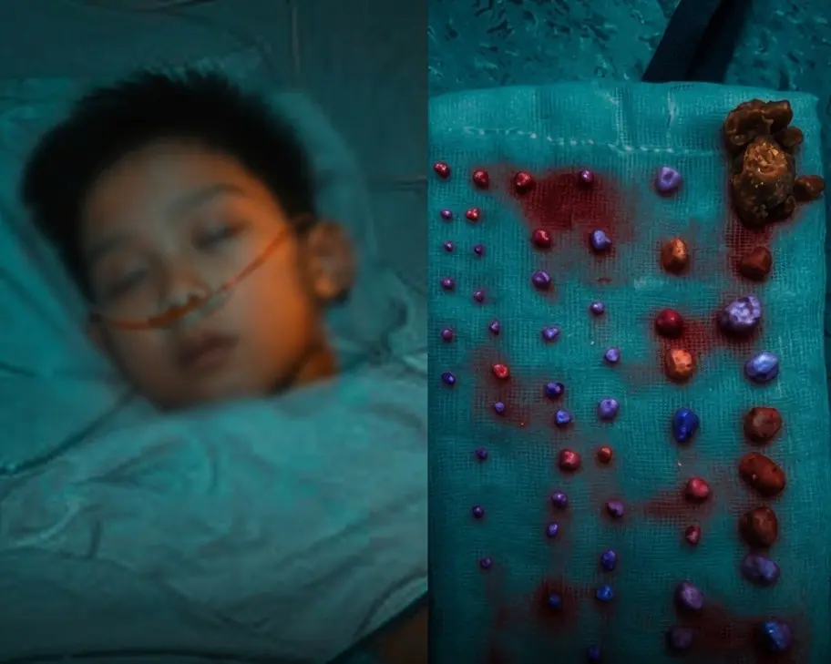 9-Year-Old Boy Found With 56 Stones in His Abdomen — Doctor Reveals the Cause, Mother Breaks Down After Learning It Was Something She Gave Him Every Day