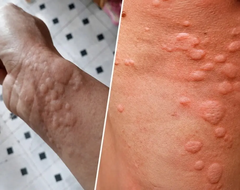 Thought It Was Just an Allergy, but Doctors Discovered an Unexpected Truth