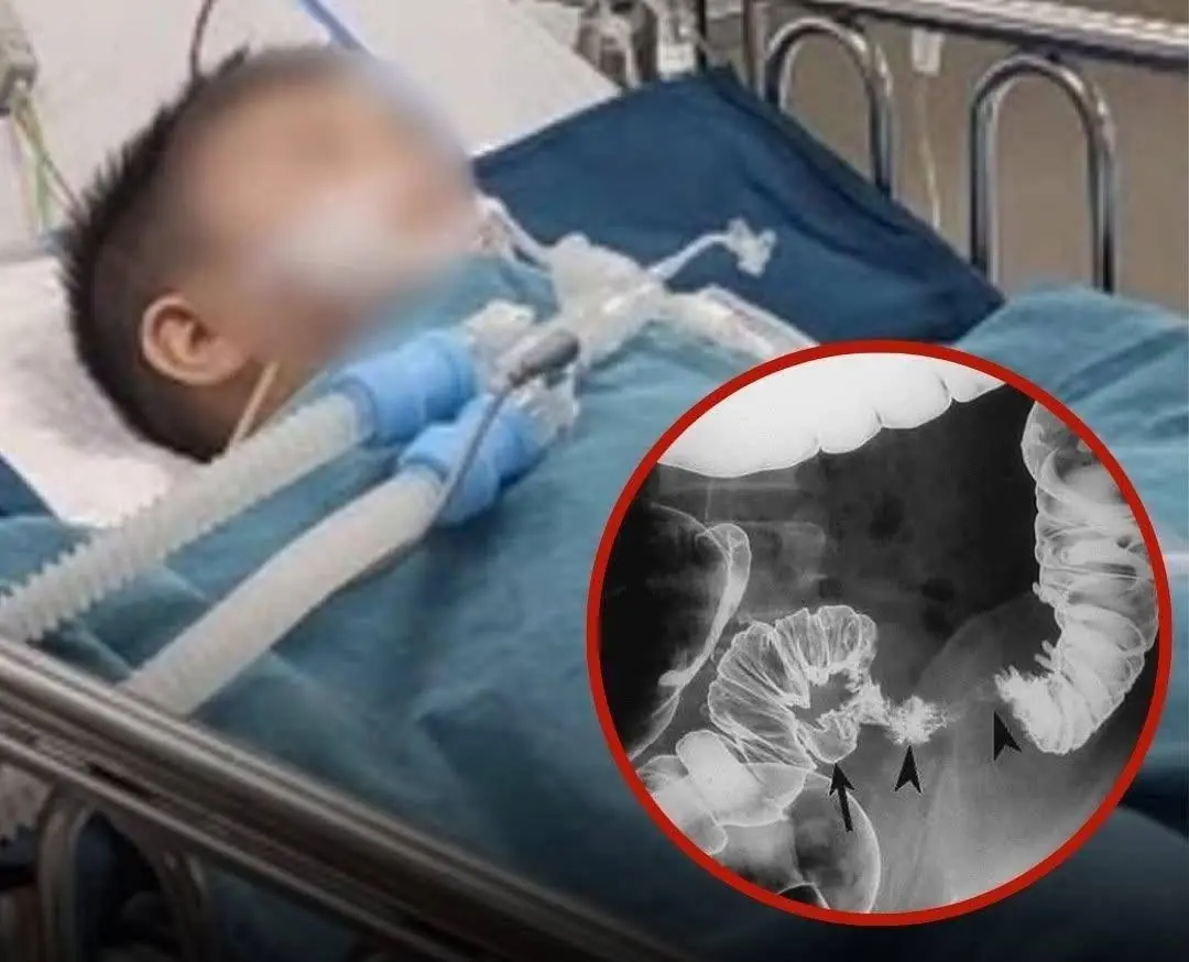 Second-Grader Diagnosed with Colon C.anc.er After Regularly Eating These 2 Foods Since Childhood