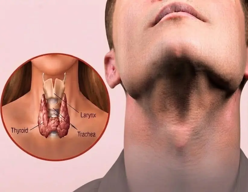 Your Diet Can Influence Thyroid Health - Here's What to Know About These 6 Foods..