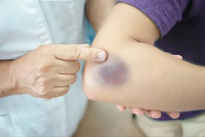 Don’t Ignore These Unusual Bruises — They Could Be Linked to Certain Health Conditions