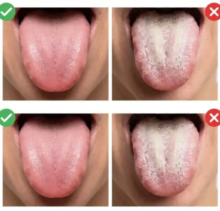 What a White Tongue May Be Telling You About Your Health?