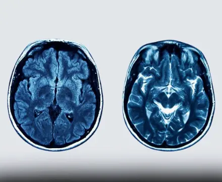 What Chronic Sleep Loss Can Do to the Brain: The Hidden Effects You Should