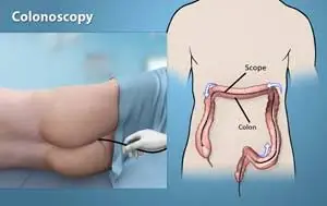 Doctor Ordered a Colonoscopy? Here’s a Question You Shouldn’t Forget to Ask