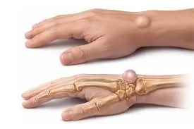 Don’t Ignore a New Lump on Your Wrist—Here Are Some Common Causes